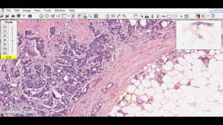 Breast ductal carcinoma Breast cancer [upl. by Kaspar563]