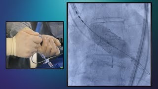 TAVR Utilizing the Medtronic Evolut Pro Transcatheter Heart Valve [upl. by Idonah]