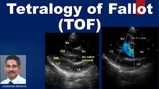 Tetralogy of Fallot TOF [upl. by Oigroeg]