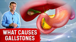 What Really Causes Gallstones  Dr Berg [upl. by Stambaugh]