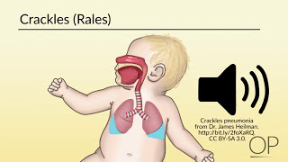 The Coughing Child and Pneumonia [upl. by Caril]