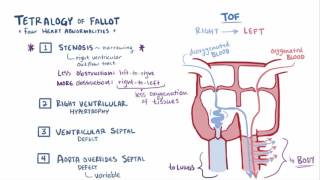 Tetralogy of Fallot 4 vessel view with colour Doppler [upl. by Also463]