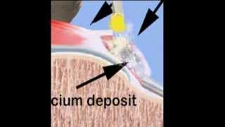 Calcium Removal [upl. by Andrel]