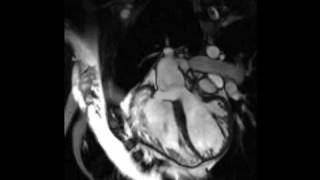 Cardiac MRI  Tetralogy of Fallot [upl. by Kinch]