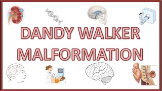 Dandy Walker Syndrome  Causes Signs amp Symptoms Pathophysiology Diagnosis [upl. by Bust]