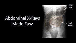 Abdominal XRays Made Easy [upl. by Namsaj]