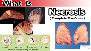 What is Necrosis  Complete Overview [upl. by Adnawed816]