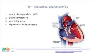 Tetralogy of Fallot Repair [upl. by Aicnilav290]