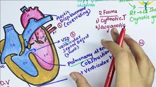 Mayo Clinic – Tetralogy of Fallot [upl. by Niuqram]