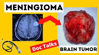 What Is A Meningioma Tumor [upl. by Durward]